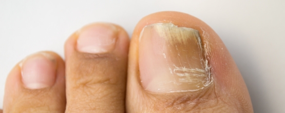 What causes orange toenails?